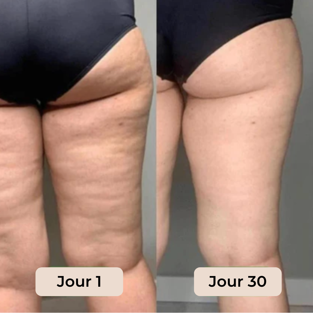 Pourquoi la cellulite touche 80% des femmes au Québec — et comment y remédier | Direct Québec
